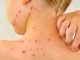 Rujeola face ravagii în România