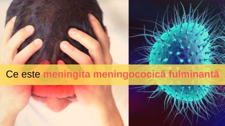 Ce este meningita meningococică fulminantă. Decesul este frecvent