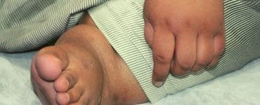 La doar 10 ani, un băiat din Pakistan cântărește 200 de kilograme, fiind considerat cel mai gras copil din lume. Mohammad Abrar l-a eclipsat pe Arya Permana, un băiat din Indonezia, care acum 3 ani - pe când avea vârsta de acum a pakistanezului - cântărea 190 de kilograme. La naștere, Mohammad Abrar cântărea doar 2,7 kilograme, dar la 6 luni a început să ia proporții. Mama, Zareena Yasmeen, spune că foamea fiului ei este permanentă și a mâncat mereu de cinci ori mai mult decât frații lui. Copilul a fost diagnosticat cu obezitate morbidă. Medicii spun că viața lui este în pericol în fiecare clipă, având inima învelită într-un strat gros de grăsime. Deși are doar 10 ani, Mohammad Abrar conștientizează că este într-o situație foarte delicată și vrea să slăbească urmând indicațiile medicilor.