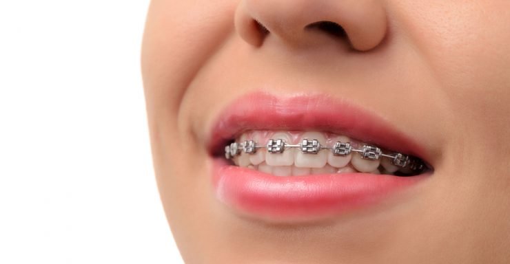 Lucruri pe care trebuie să le știi înainte să-ți pui aparat dentar