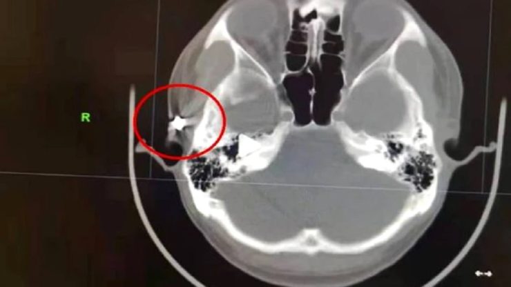 Halucinant ce au descoperit medicii în craniul unui tânăr ajuns la spital cu dureri groaznice de cap. Zăcea acolo de mai bine de 20 de ani 25 tanar cu glont in cap