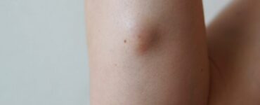 Umflătură sub piele cu durere. Când trebuie să mergi la doctor pentru a nu-ți pune în pericol sănătatea