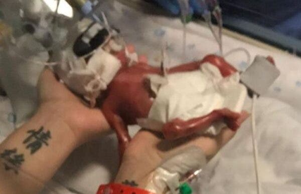 Bebelușul „miracol”, născut prematur: e mai ușor decât o conservă de fasole. Fratele geamăn nu a supraviețuit
