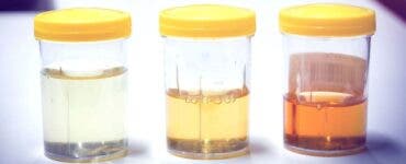 Ce spune culoarea urinei despre sănătatea ta