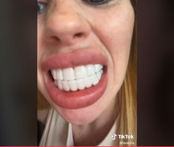 O tânără și-a cumpărat fațete dentare de pe net și acum face haz de necaz: „Arăt ca un cal!” 27 fateta dentara