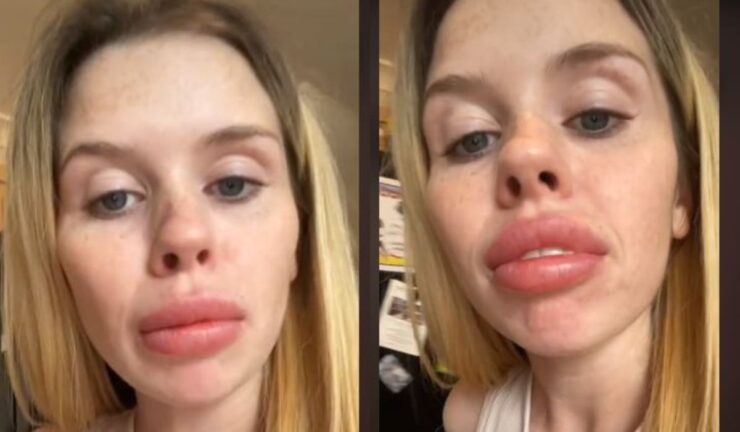 O tânără și-a cumpărat fațete dentare de pe net și acum face haz de necaz: „Arăt ca un cal!” 25 O tânără și-a cumpărat fațete dentare de pe net și acum face haz de necaz: „Arăt ca un cal!”