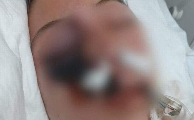 Medicii au vrut să îi înlăture un ochi și o parte din față unei adolescente care suferea de „ciuperca neagră”