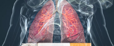 cancer pulmonar