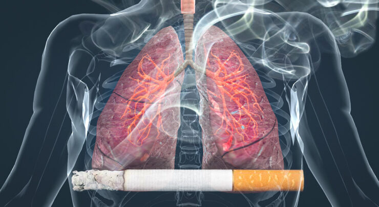 cancer pulmonar