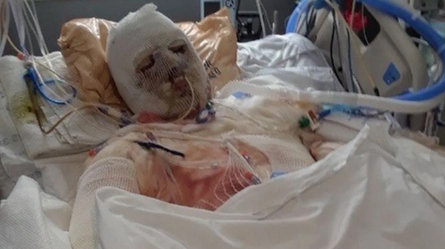 Cum arată acum primul om cu transplant de față și mâini. Tânărul de 24 de ani poartă chipul unui bărbat de 48 de ani 28 transplant de față și mâini