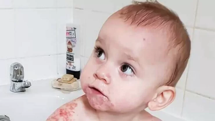 Sărutul morții! Un bebeluș a ajuns pe patul de spital după ce o rudă l-a pupat pe buze. Mama povestește înmărmurită ce s-a întâmplat 25 herpes bucal riscuri