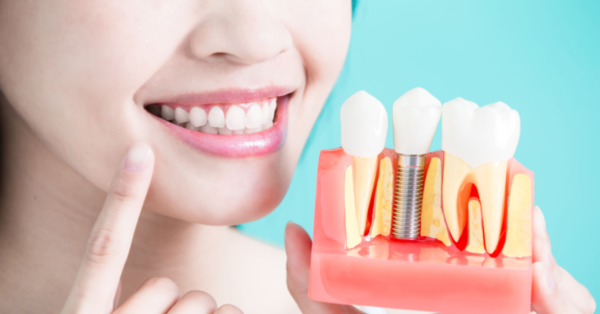 Implanturile dentare: riscuri și beneficii 25