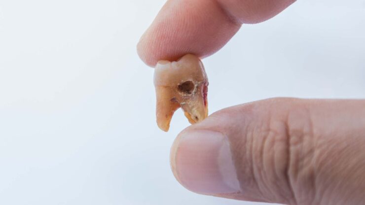 Caria dentară de azi poate fi coroana dentară de mâine 25
