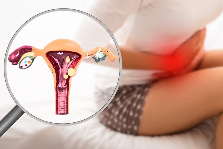 Boala femeilor neiubite: Ce este endometrioza 25