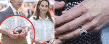 De ce are Kate Middleton degetele bandajate?!