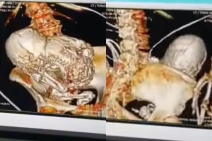 Daniela a ținut timp de 56 de ani un bebeluș pietrificat în burtă. Femeia nu a știut că a rămas însărcinată: „Nu-i plăcea să meargă la medic” 25 O femeie a ținut un bebeluș pietrificat în burtă timp de 56 de ani.