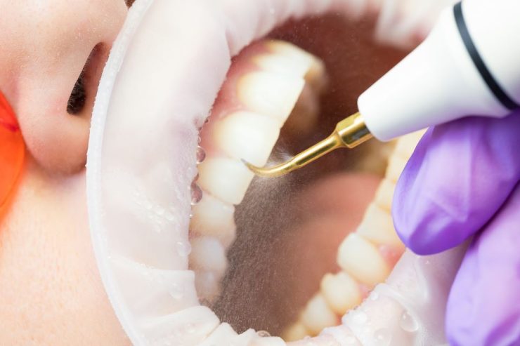 Când este recomandată procedura de detartraj cu ultrasunete? 25