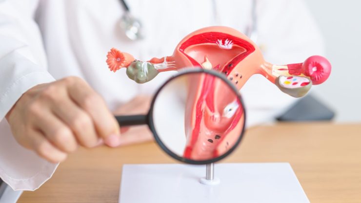 Primele simptome ale fibromului uterin: cum le identificăm? 25