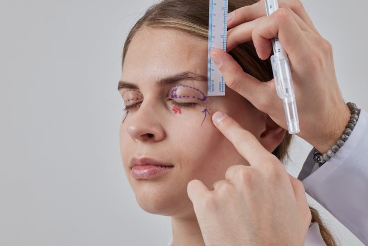 Blefaroplastia: ce trebuie să știi despre chirurgia pleoapelor pentru un look întinerit? 25