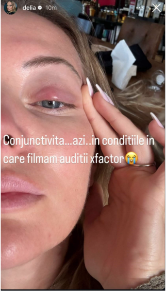 Ghinionul continuă pentru Delia. După accidentarea la picior, acum se confruntă și cu o problemă la ochi. Artista împărtășește momentele dificile cu fanii săi 26 Sursa foto: Instagram
