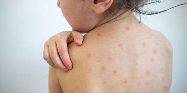 Boala contagioasă care pune întreaga țară în pericol. Medicii atrag atenția asupra riscului de răspândire