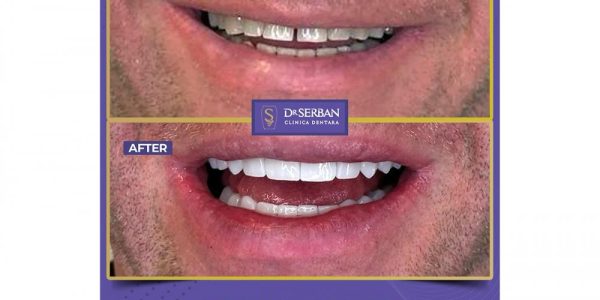 coroane dentare drserban